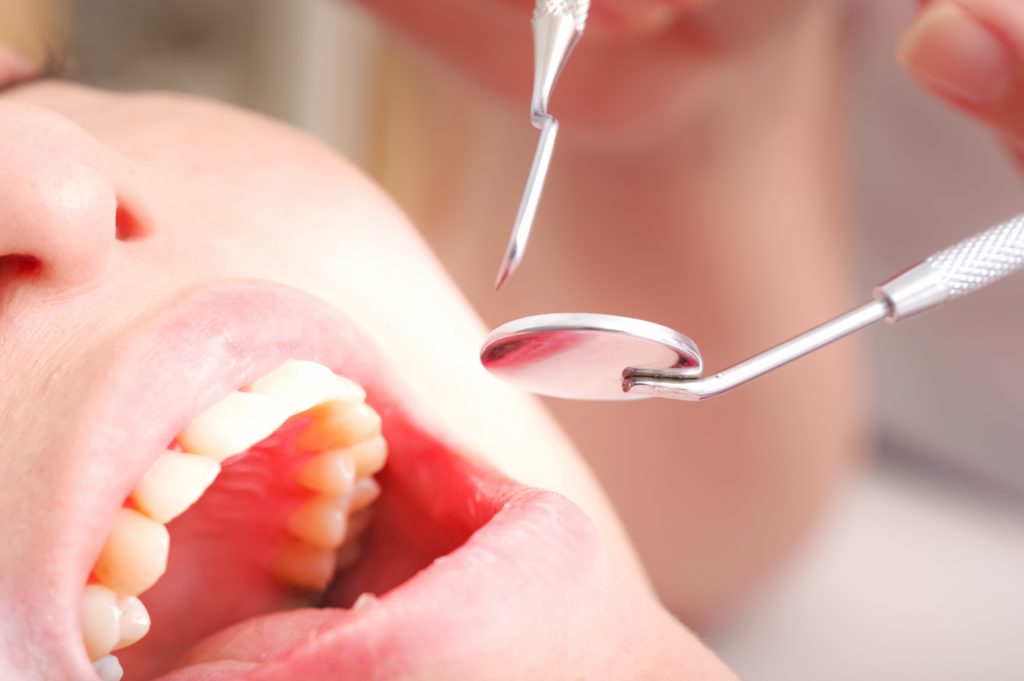 入れ歯や差し歯を選択する際の注意点